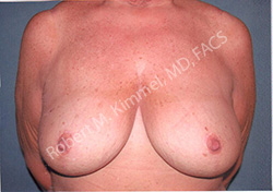 Breast Reduction Patient 58684 Photo 2