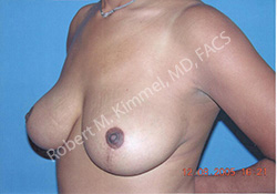 Breast Reduction Patient 23656 Photo 2