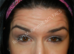 Botox Treatments Patient 70150 Photo 1