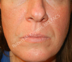 Facial Rejuvenation Patient 97101 Photo 1