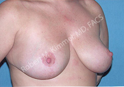 Breast Reduction Patient 45331 Photo 2