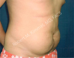 Male Abdominoplasty Patient 91334 Photo 1