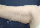 Arm Lift (Brachioplasty) Patient 25859 Photo 1