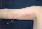Arm Lift (Brachioplasty) Patient 25859 Photo 2