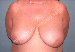 Breast Reduction Patient 58684 Photo 1