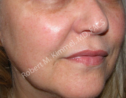 Facial Rejuvenation Patient 69306 Photo 2