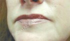 Lip Lift Patient 16141 Photo 1
