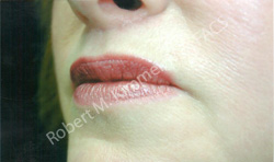 Lip Lift Patient 16141 Photo 2