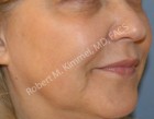 Facial Rejuvenation Patient 69306 Photo 1