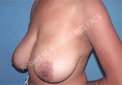 Breast Reduction Patient 23656 Photo 1