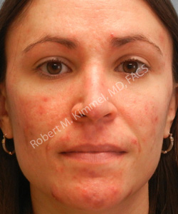 Acne Treatment Patient 92772 Photo 1
