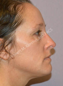 Thermage CPT® Patient 99327 Photo 1
