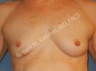 Breast Reconstruction Patient 41583 Photo 1