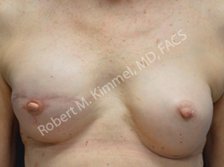 Breast Reconstruction Patient 41583 Photo 2