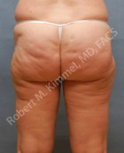 Liposuction Patient 54530 Photo 1
