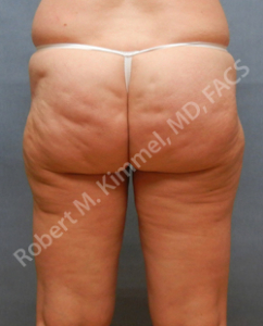 Liposuction Patient 54530 Photo 1
