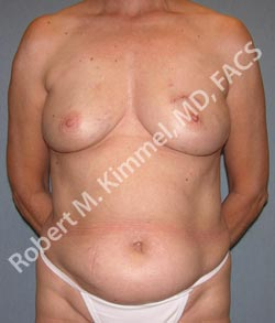 Breast Reconstruction Patient 23115 Photo 1