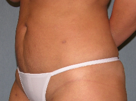 Liposuction Patient 61569 Photo 1