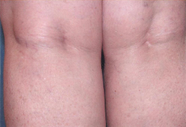 Injection Sclerotherapy Patient 44132 Photo 2