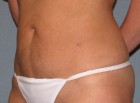 Liposuction Patient 61569 Photo 2