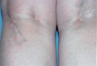Injection Sclerotherapy Patient 44132 Photo 1
