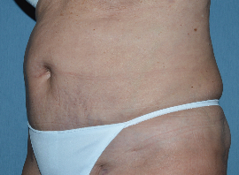Liposuction Patient 21793 Photo 2