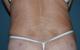Liposuction Patient 92259 Photo 2