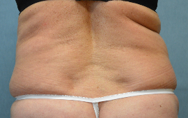 Liposuction Patient 92259 Photo 1