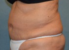 Liposuction Patient 21793 Photo 1