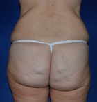 Liposuction Patient 27418 Photo 1