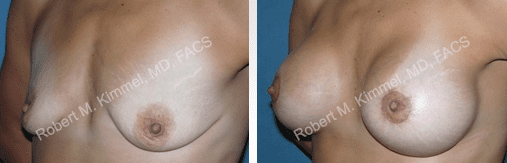 Breast lift - before and after