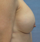 Breast Augmentation Patient 14026 Photo 1