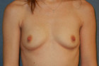 Breast Augmentation Patient 30805 Photo 1