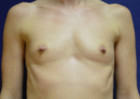 Breast Augmentation Patient 27146 Photo 1