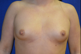 Breast Augmentation Patient 60098 Photo 1