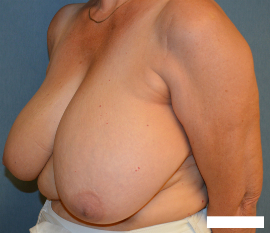 Breast Reduction Patient 55880 Photo 1