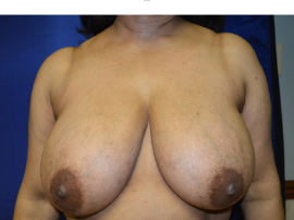 Breast Reduction Patient 74107 Photo 1