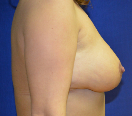 Breast Reduction Patient 33332 Photo 2