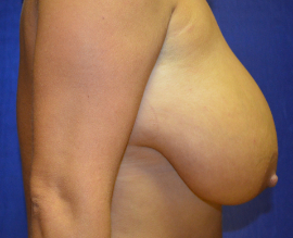 Breast Reduction Patient 33332 Photo 1