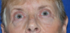 Eye Lift – Blepharoplasty Patient 29813 Photo 2