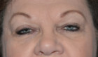 Eye Lift – Blepharoplasty Patient 82712 Photo 1