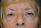 Eye Lift – Blepharoplasty Patient 29813 Photo 1