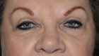 Eye Lift – Blepharoplasty Patient 82712 Photo 2
