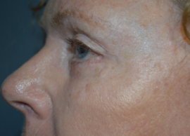 Eye Lift – Blepharoplasty Patient 95694 Photo 2