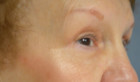 Eye Lift – Blepharoplasty Patient 78144 Photo 2