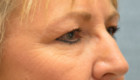 Eye Lift – Blepharoplasty Patient 83474 Photo 1