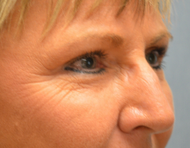 Eye Lift – Blepharoplasty Patient 83474 Photo 2