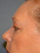 Eye Lift – Blepharoplasty Patient 95694 Photo 1