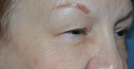 Eye Lift – Blepharoplasty Patient 78144 Photo 1