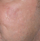Micro-Needling with Platelet Rich Plasma Patient 40468 Photo 2